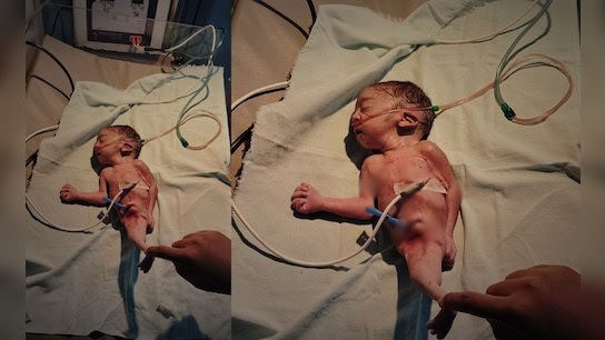 छत्तीसगढ़ के धमतरी में जन्मा जलपरी जैसा दिखने वाला बच्चा, 3 घंटे बाद मौत, छत्तीसगढ़ का पहला भारत का पांचवा और दुनिया में सिर्फ 300 ऐसे मामले